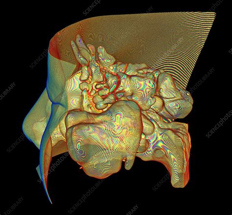 Paranasal Sinuses And Nose 3d Ct Scan Stock Image C0400956