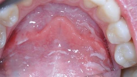 What Does The First Stages Of Mouth Cancer Look Like Detection Of