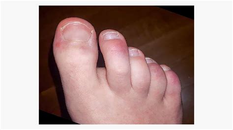 Are Sores On Your Feet A Symptom Of Covid 19