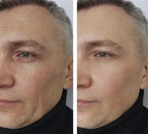 Hombre Arrugas En La Cara Paciente De La Diferencia De La Terapia De