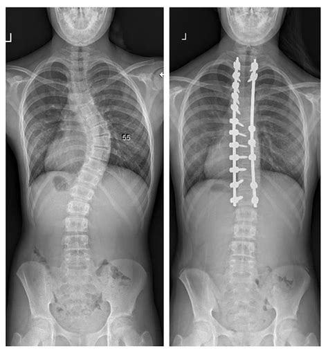 Scoliosis Before After