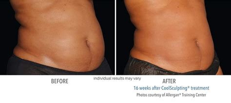 Coolsculpting Before And After Results From Actual Patients