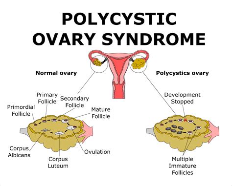 Mohak Infertility Center What Is Polycystic Ovary Syndrome