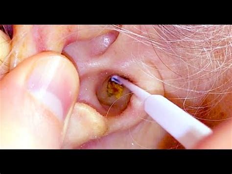 Big Ear Wax Removal Extreme Extractions YouTube