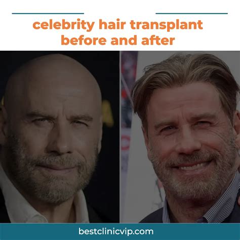 Celebrity Hair Transplant Before And After Vip Clinic