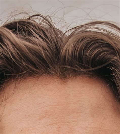 How To Tell If You Have A Receding Hairline