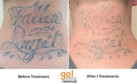 Tattooremovalcost Laser Tattoo Removal Laser Tattoo Tattoos