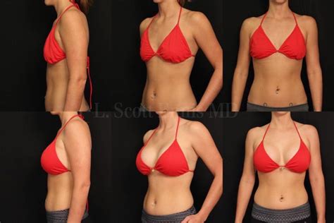 Large Breast Augmentation Before After