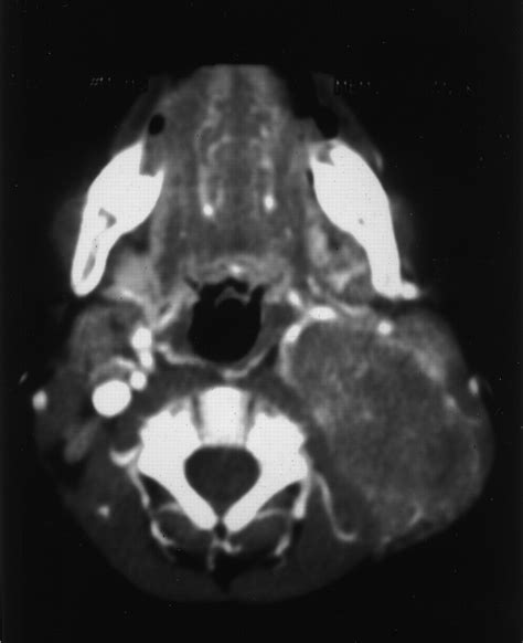 Neuroblastoma A Disease Requiring A Multitude Of Imaging Studies