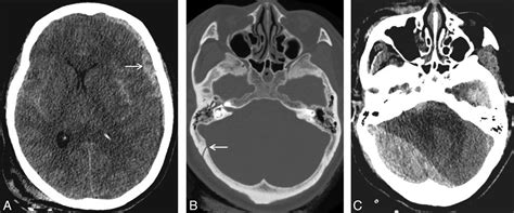 Calvarial Fracture Patterns On Ct Imaging Predict Risk Of A Delayed