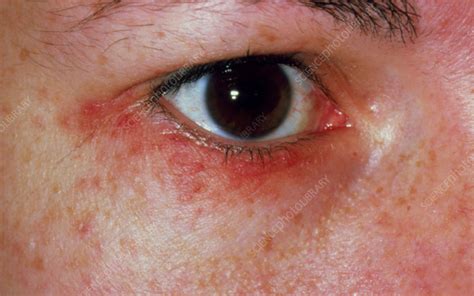 Acne Agminata Rash Around Womans Eye Stock Image M1080175