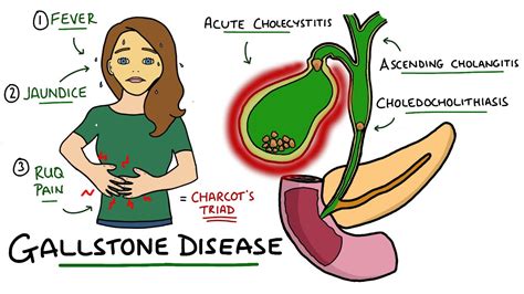 The Right Code For Acute Cholecystitis And Cholelithiasis