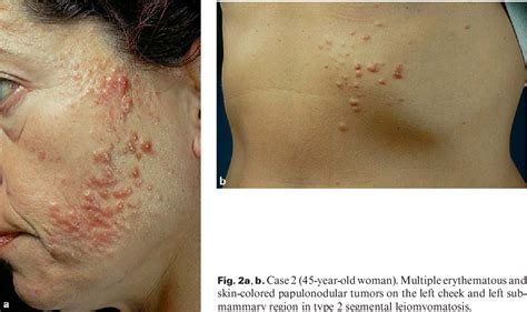 Figure 2 From Type 2 Segmental Manifestation Of Cutaneous