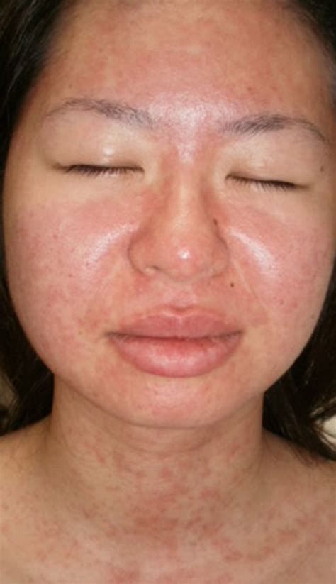 Skin Rash In A Patient With Infectious Mononucleosis Bmj Case Reports