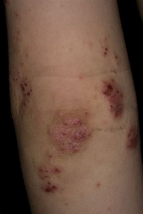 Eczema On Elbows Pictures 9 Photos And Images