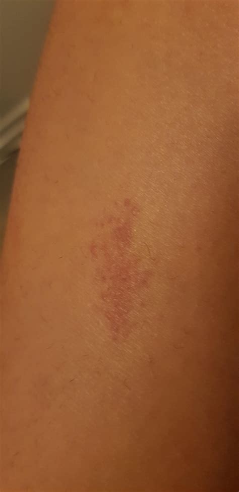 2 Week Old Rash On Left Calf That Doesnt Itch I Noticed Only When