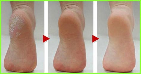 Dead Skin Under Feet Causes Symptoms And Treatment Сухие пятки