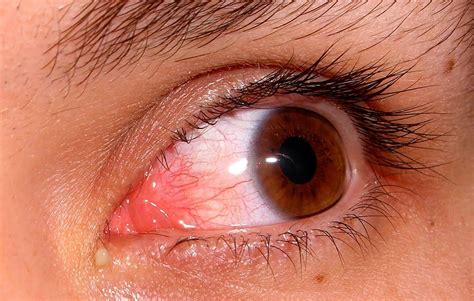 Герпес на глазу офтальмогерпес фото симптомы причины лечение