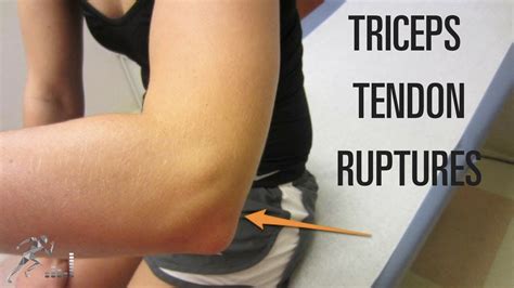 Triceps Tendon Rupture Mechanism Of Injury And Treatment Youtube