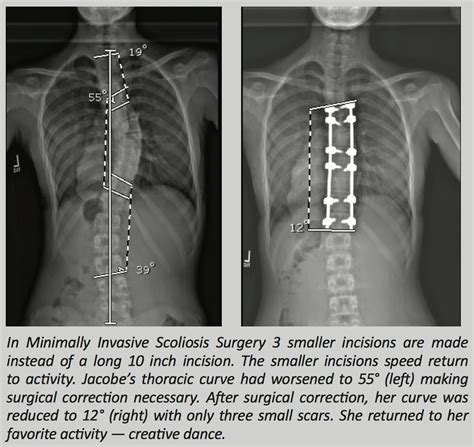 Scoliosis Texas Minimally Invasive Scoliosis Surgery
