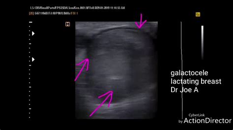 Galactocele Lactating Breast Youtube