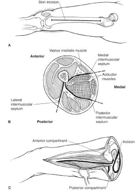 Anterior Thigh Compartment Syndrome Captions Lovers