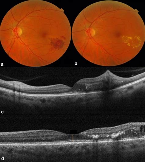 Direct Navigated Laser Photocoagulation As Primary Treatment For