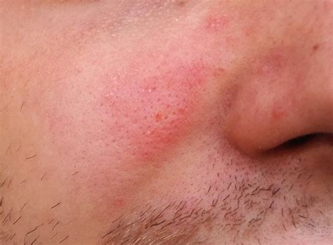 What Are These Tiny Red Spots On My Skin Causes Remedies