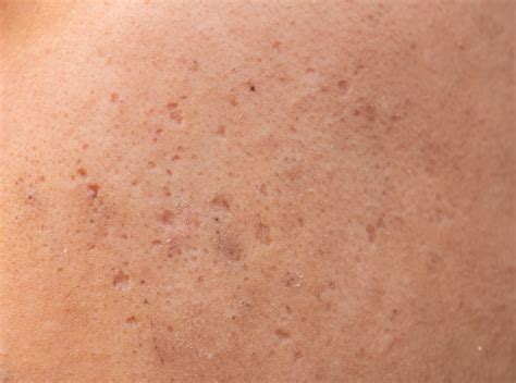 Treating Rolling Acne And Box Scars A Doctor Shares Tips Human