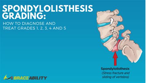 Spondylolisthesis Grading How To Diagnose And Treat Grades 1 2 3 4