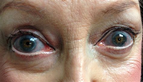 Derm Dx Blue Sclera In A Patient With Skeletal Fractures Clinical