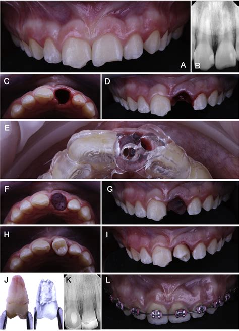 Fully Guided Tooth Autotransplantation Using A Multidrilling Axis