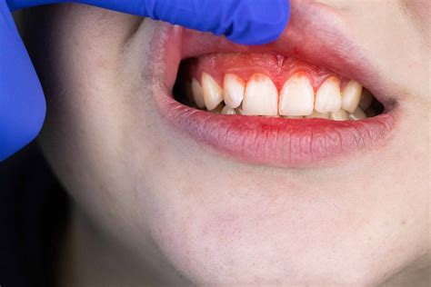 Periodontal Disease Or Gum Disease What Is It And How Do We Treat It Gum Disease Treatment
