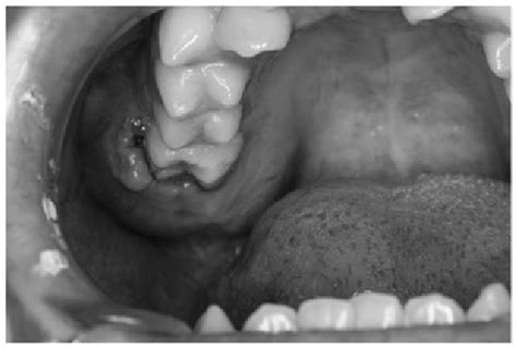 Clinical Examination Intraoral Image Revealing A Mass With An Elastic