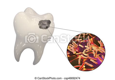 La carie est une maladie infectieuse qui se développe sur les dents. Carie dentaire, dent. Gros plan, microbes, dentaire ...