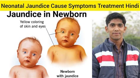 Neonatal Jaundice Cause Symptom Treatment In Hindi What Is Neonatal