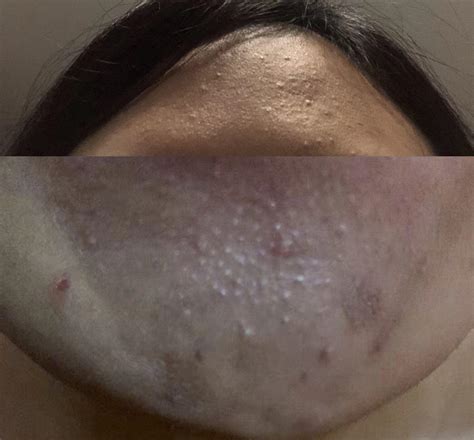 Routine Help How Can I Get Rid Of These Bumps On My Forehead And Chin