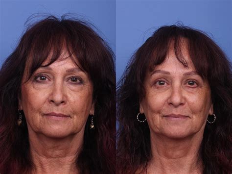 Blepharoplasty Before And After Pictures Case 320 Scottsdale And Phoenix Az Hobgood Facial