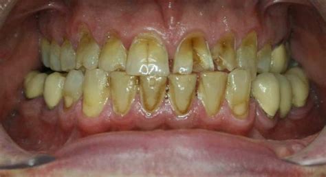 Composite Bonding - Earlsfield Dental Studios Dentist- Minimally ...