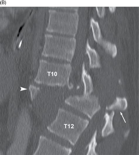 Fractures And Dislocations Of The Thoracolumbosacral Spine Anesthesia Key