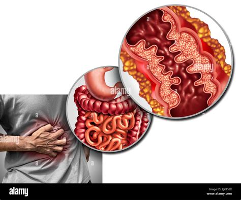 Enfermedad de Crohn Dolor y síndrome de Crohn Enfermedad o Trastorno de crohns como concepto