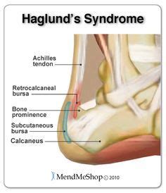 Haglund S Syndrome Inflammation In The Achilles Tendon And Retrocalcaneal Bursa Achilles