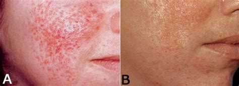 Laser Treatment Of Atrophoderma Vermiculata Journal Of The American