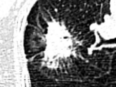 Solitary Pulmonary Lesions Were Visually Classified Into 5 Levels