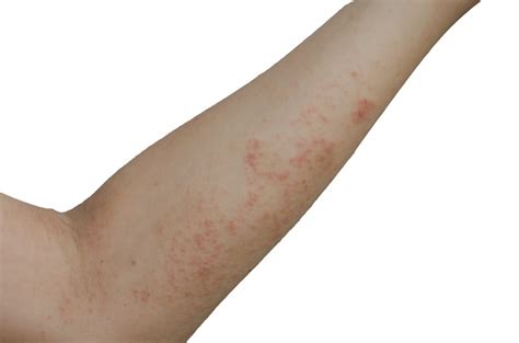 Identifying Scabies Bites Thriftyfun