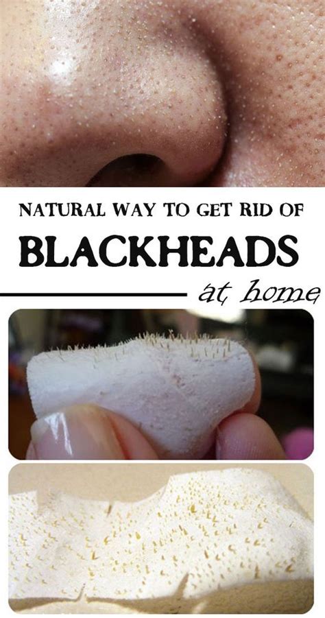 Easy And Super Working Natural Ways To Get Rid Of Blackheads At Home