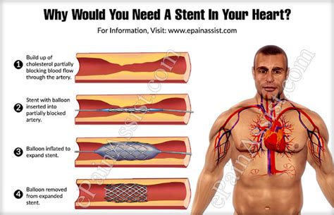 Why Would You Need A Stent In Your Heart