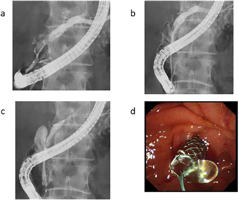 Placement Of A Mm Fully Covered Metal Stent For Main Pancreatic Head