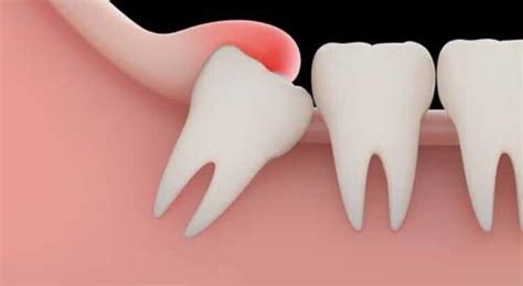 Managing Wisdom Tooth Pain At Home Without Seeing A Dentist