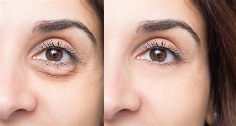How Restylane Can Fix Your Undereye Bags San Diego Dermatologist